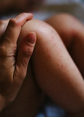 Childs skin condition