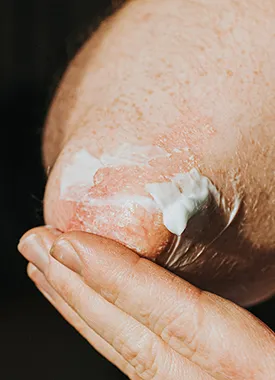 Emollient on elbow