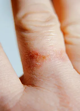 Skin condition on hand