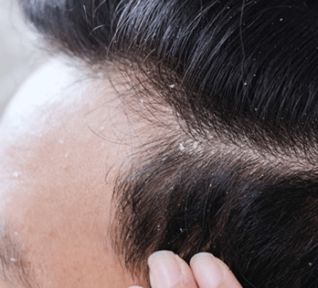 Person with dandruff in their hair