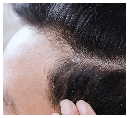 Eczema Dermititis