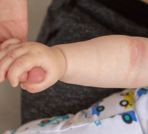 Baby with eczema on their arm