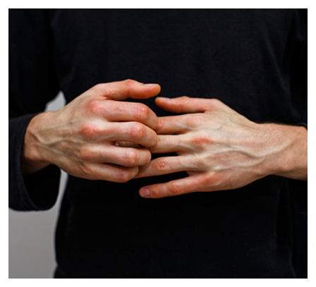 Eczema Dermititis